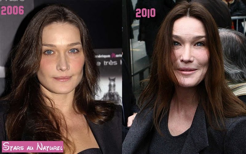 carla-bruni-chirurgie